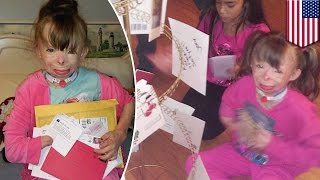 Christmas wish comes true after 5-year-old burn victim's story goes viral - TomoNews