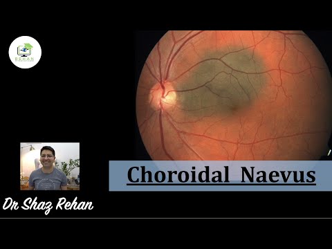 Choroidal Naevus: What is it? How is it Diagnosed? Treatment? What Else Could it be? I Rehan, 2021