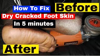 How To Fix Dry Cracked Feet Skin In 5 minutes Very Quickly