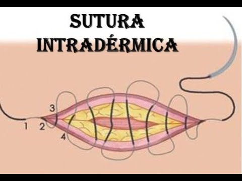 Sutura Intradérmica
