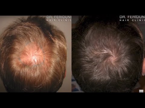 Haartransplantation Tonsur Verdichtung: Dr. Feriduni FUT Haartransplantation 1180 Grafts Tonsur