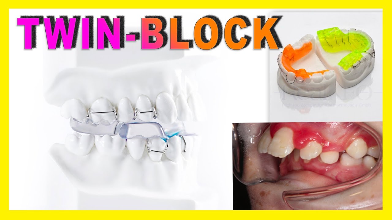 ♦️TWIN BLOCK♦️ Aparato dental para NIÑOS para corregir HIPOPLASIA MANDIBULAR