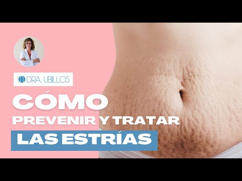 CÓMO PREVENIR Y TRATAR LAS ESTRÍAS