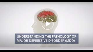 Understanding Disease Pathology of Major Depressive Disorder (MDD)