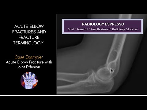 RADIAL HEAD/NECK FRACTURES, HOW TO IDENTIFY OCCULT FRACTURE: Case Example - Occult Elbow Fracture