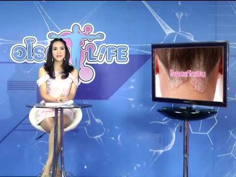 Guttate สะเก็ดเงินโซเดียมไธโอซัลเฟต รากสีน้ำเงินของโรคสะเก็ดเงิน