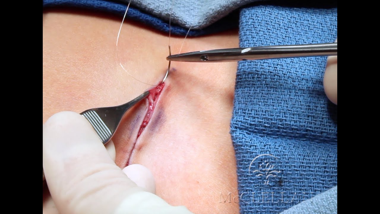 Live Surgery: Running Subcuticular Suture. What is an Intracuticular or Subcuticular Suture