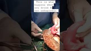 Taking out roundworms from patient