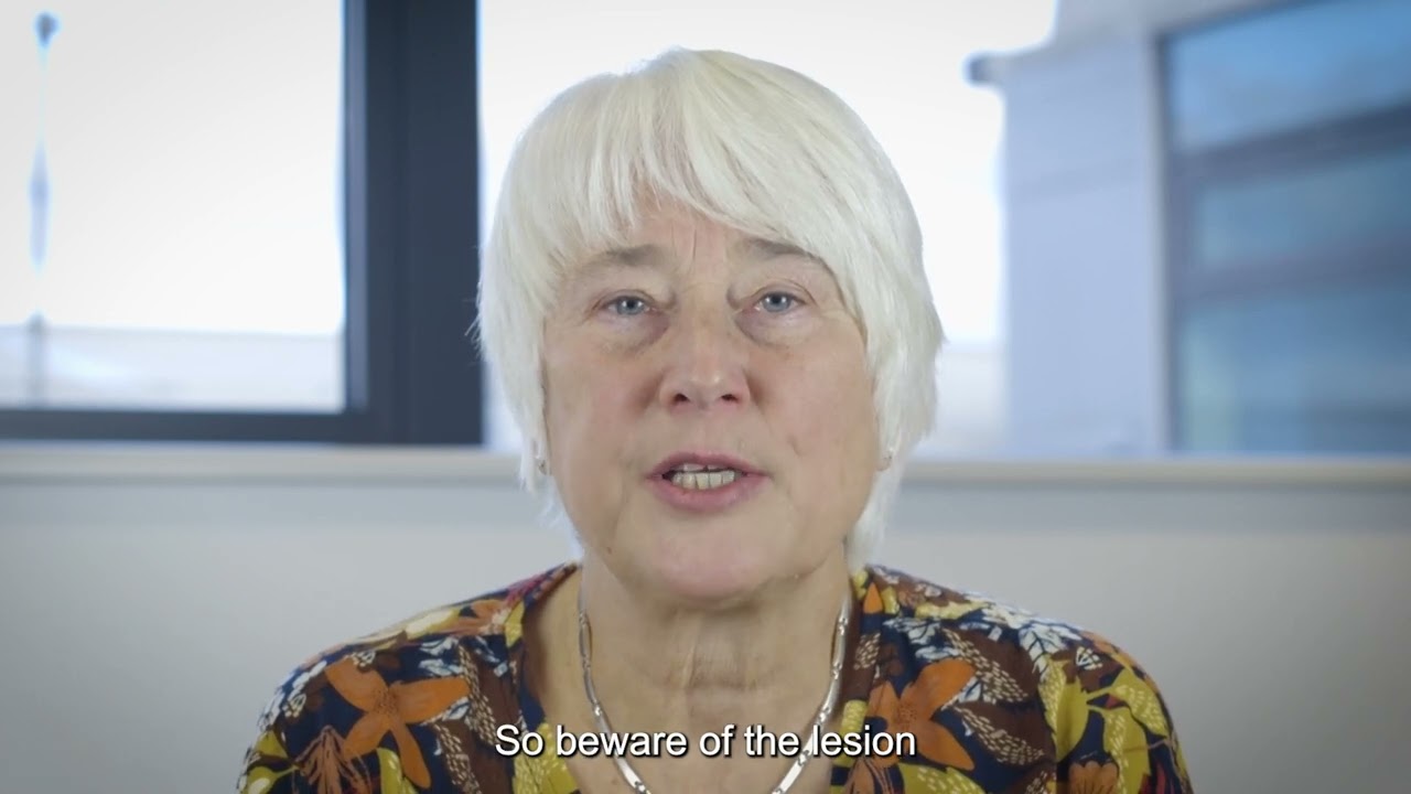 Be aware of the ugly duckling &ndash; Dermoscopy