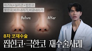 8차 코재수술 찝힌코·극한코 재수술 [늑떼선생김현주의 수술사례 및 케이스리뷰]