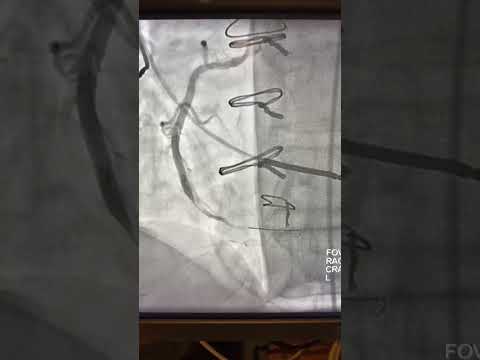 CTO RCA- IVL Lithotripsy shockwave, step by step !