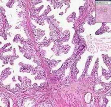Adenocarcinoma prostate gleason 6