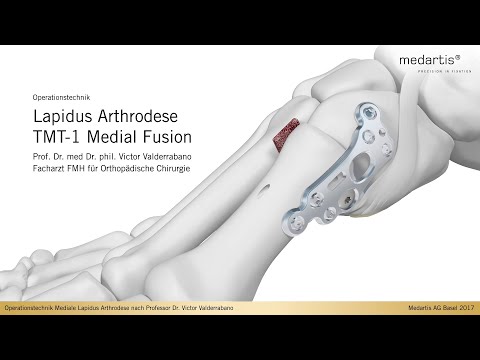 APTUS Foot Hallux System 2.8 Lapidus Arthrodese TMT-1 Medial Fusion OP Technik