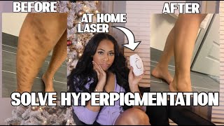 HOW TO FIX HYPERPIGMENTATION FAST: MY AT HOME LASER HAIR REMOVAL HORROR STORY.