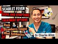 Scarlet Fever Signs And Symptoms Complications And IGAS Antibiotics Options