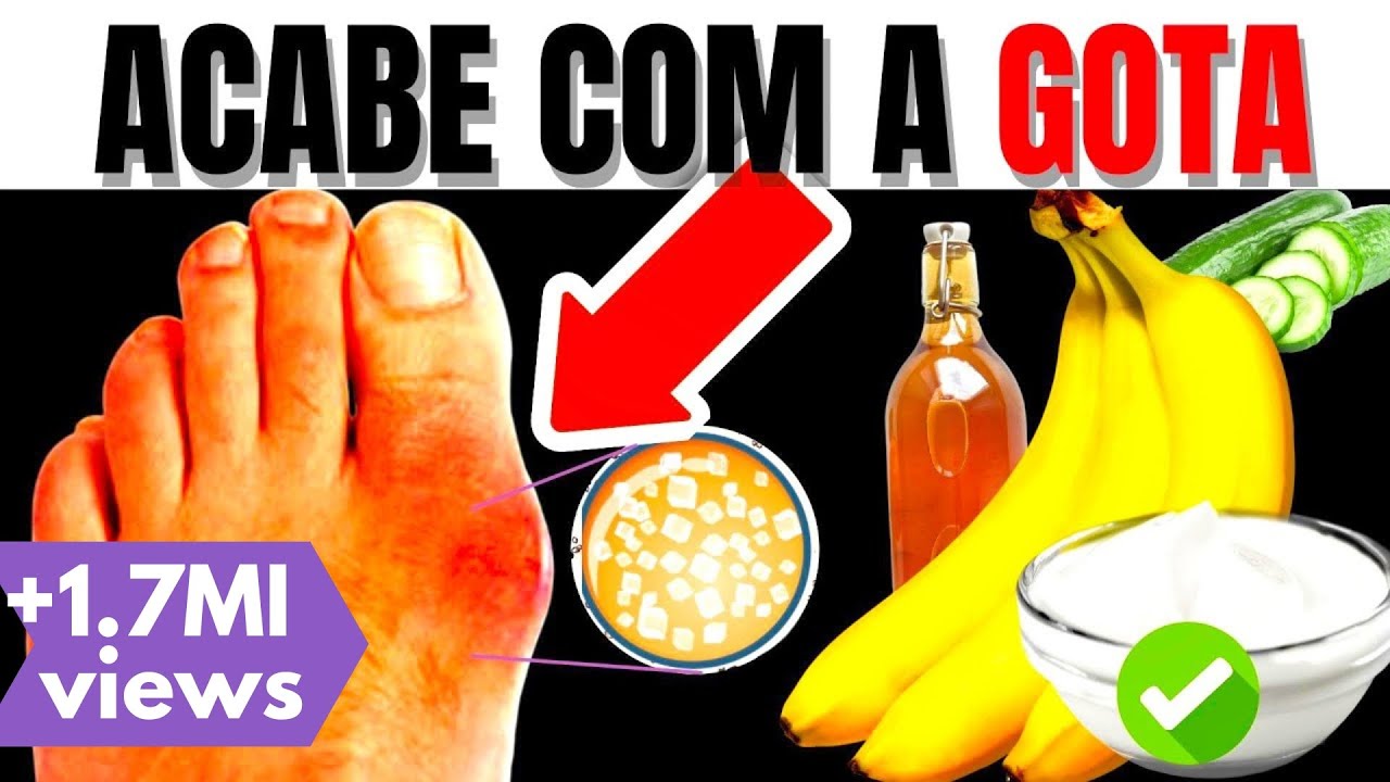 Watch Now 10 ALIMENTOS PARA ACABAR com a GOTA e para BAIXAR o ÁCIDO ÚRICO ALTO DO SANGUE 10 ALIMENTOS PARA ACABAR com a GOTA e para BAIXAR o ÁCIDO ÚRICO ALTO DO SANGUE