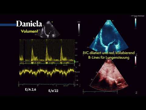 Diastolische Dysfunktion, PW-Doppler & Volumenstatus im Ultraschall  〖Ultraschall〗 💘💫