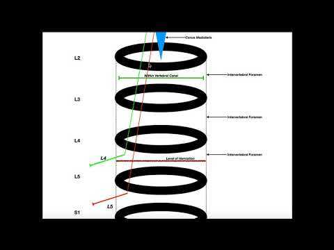 Relation Between Disc Herniation & Compressed Nerve Root Levels
