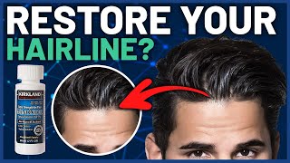 Minoxidil for Frontal Baldness - Restore Your Hairline?