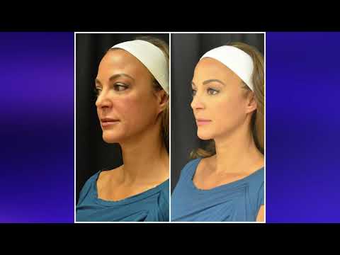 GUANCHELIFT: FACELIFT WITHOUT SURGERY