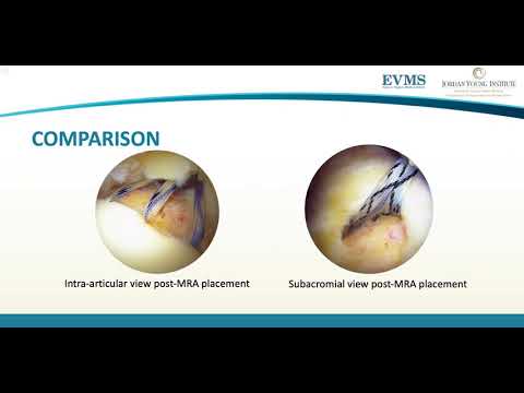 Thumbnail image of video presentation for Optimizing Anchor Placement for Cone-Shaped Rotator Cuff Tears