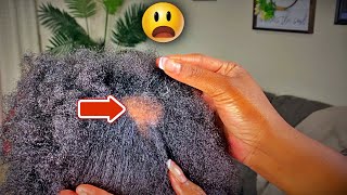 How to Treat Bald Spots & Thinning Hair Naturally | Regrow Your Hair Naturally