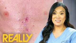 Dr Lee Pops Over 40 Pimples From Patient&#39;s Chest | Dr Pimple Popper: Pop Ups