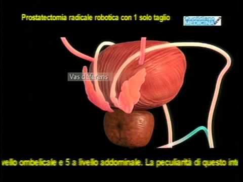 Cambiamenti diffuse della prostata per tipo prostata Antibiotici per prostatite