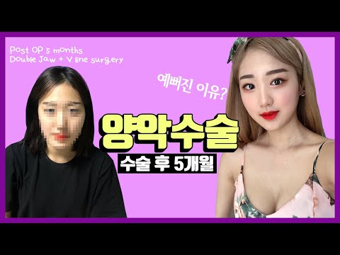 양악수술&브이라인수술 5개월차 / Post OP 5 Months Double Jaw&V-line Surgery