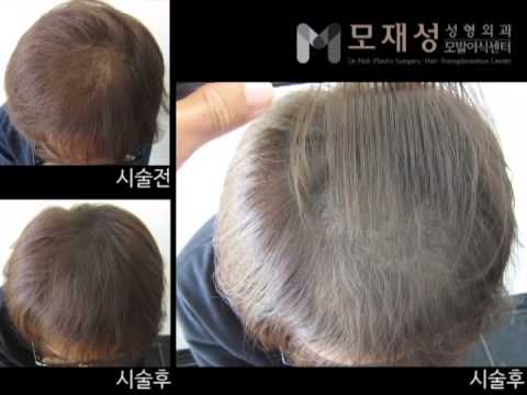 Scalp Micropigmentation Treatment (SMT), 두피문신