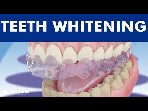Teeth whitening – How is it done? ©