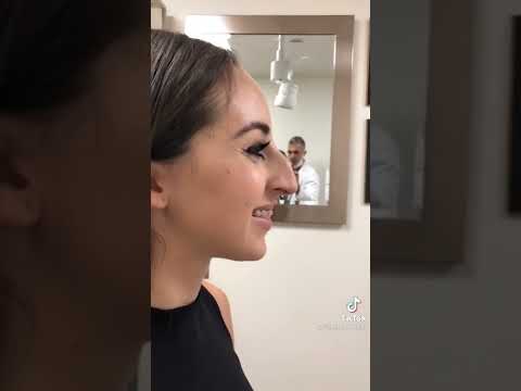 RINOPLASTIA😍, Se liga neste antes de depois de cirurgia plástica de Nariz 👃 #shorts #drrobsonpereira