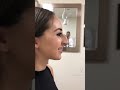 RINOPLASTIA Se Liga Neste Antes De Depois De Cirurgia Plástica De Nariz Shorts Drrobsonpereira
