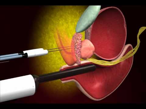 Wie Honig sbiten Prostatitis Bewertungen kochen Gegenprostatakrebschirurgie