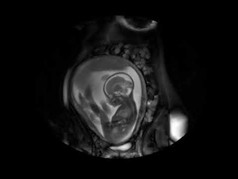 MRI scan at 28 weeks