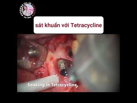 [VIETSUB] Uso de laser em implantes de Điều trị viêm quanh - peri-implantite