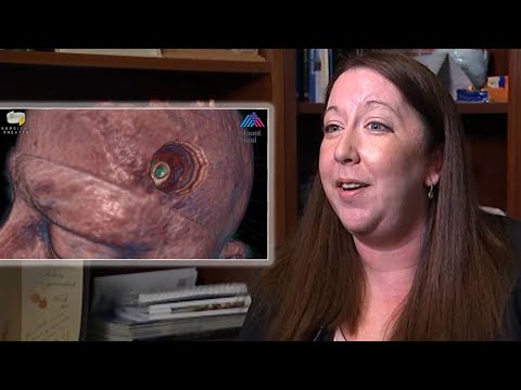 Woman relieved after 'brain tumor' turns out to be parasite