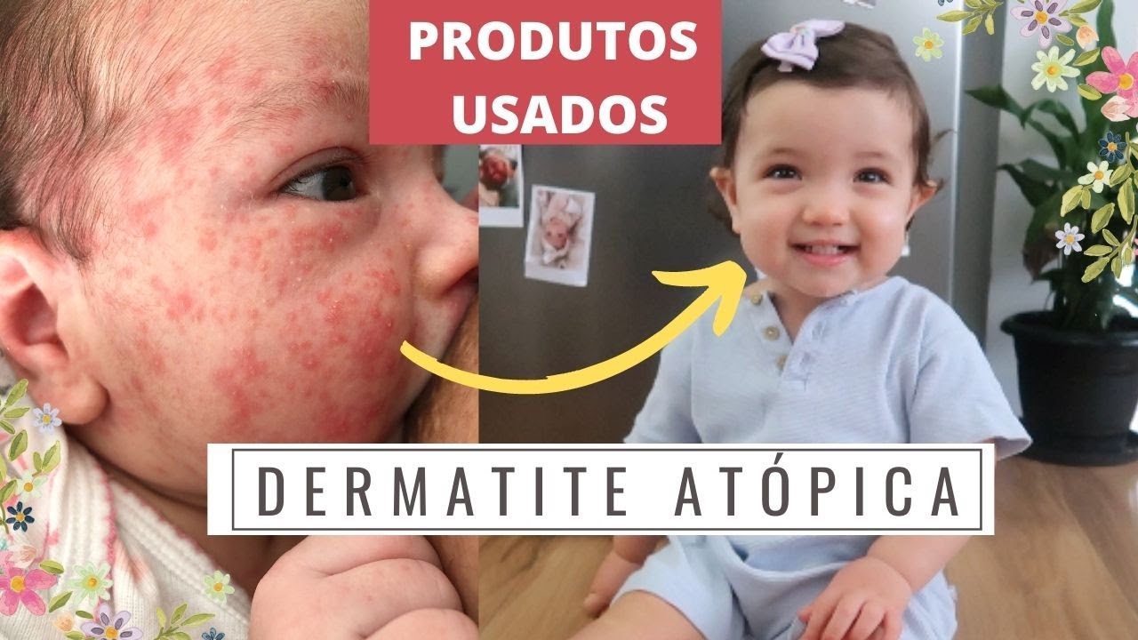 COMO CONTROLAMOS A DERMATITE ATOPICA - produtos usados e nossa historia