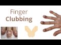 Finger Clubbing - Introduction, Pathophysiology & Causes - Mnemonic to remember causes of CLUBBING❤️