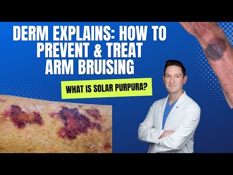 Dermatologist explains Solar Purpura (Purple Bruising on the Arms): How can you PREVENT & TREAT IT?