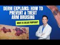 Dermatologist explains Solar Purpura (Purple Bruising on the Arms): How can you PREVENT & TREAT IT?