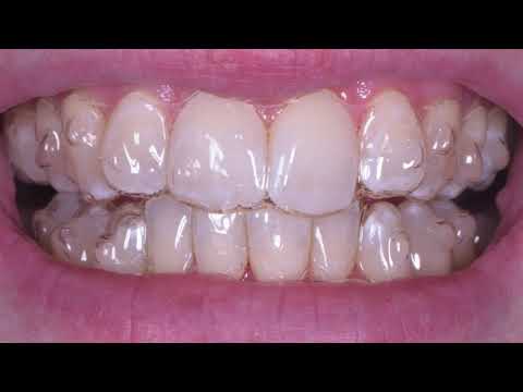 Invisalign fit appointment
