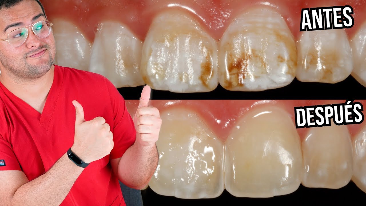 FLUOROSIS DENTAL ¿Como QUITAR estas MANCHAS de los DIENTES ¡SI SE PUEDE! 🙌