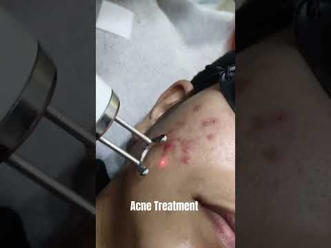 Pico Laser for Acne Treatment in Subang