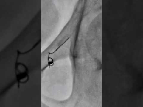 Varicocele embolization live case - Step 8 #nosurgery  | Dr. Gaurav Gangwani