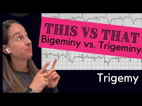 Bigeminy vs Trigeminy 🫀