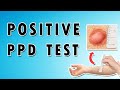 Positive PPD Test