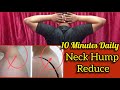 Top 10 Exercise To Reduce Neck Hump With 15 Days At Home|| Neck Hump Reduce 2022 👍