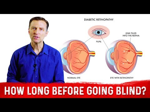 Can Diabetes Be Reversed – Dr Berg