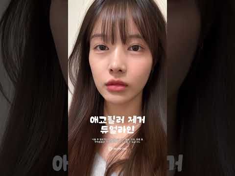 필러제거+리프팅